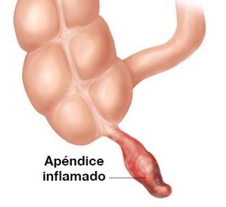 imagen apendice inflamado (apendicitis)