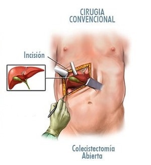 imagen cirugia tradicional (abierta) dr jose fernandez cirujano cubano en tacna