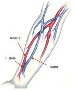 foto fistula arteriovenosa para hemodialisis dr jose fernandez cirujano cubano en tacna peru