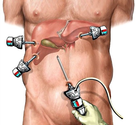 foto cirugia laparoscopica de vesicula dr jose fernandez cirujano cubano en tacna