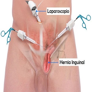 foto cirugia laparoscopica hernia inguinal