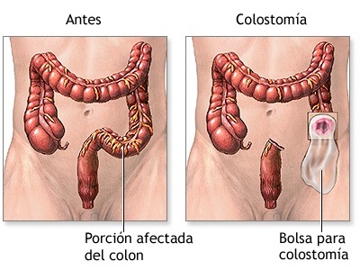 foto colostomia dr jose fernandez cirujano cubano en tacna peru