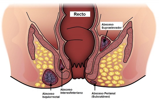 foto distintos tipos de abscesos anorectales