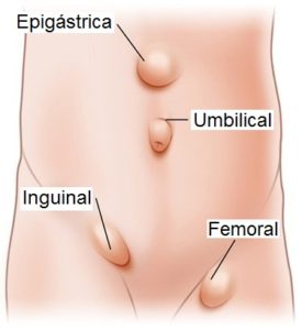 imagen con algunos tipos de hernias en la region abdominal